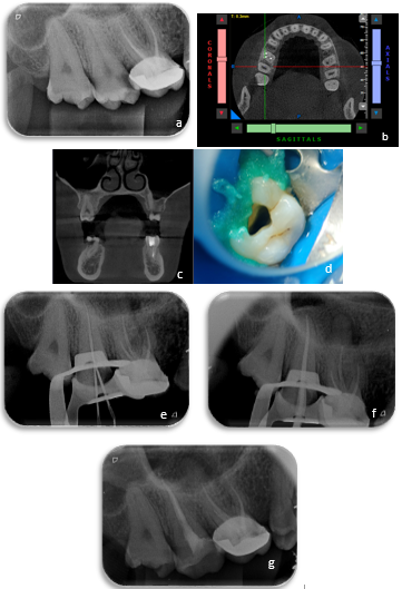 CASE 2 a: Pre-op Radiograph; b: CBCT axial view; c: CBCT sagittal view; d: Access Opening; e: Working Length Radiograph; f: Master cone Radiograph, and g: Post-op radiograph