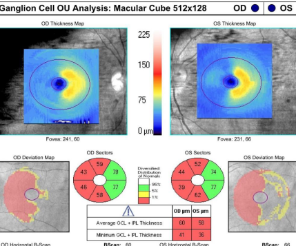 Ganglion cell thinning respecting vertical meridian corresponding to visual field defect in a post geniculate lesion