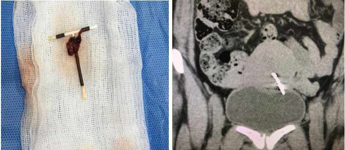 IUCD arm seen in bladder lumen in CT scan