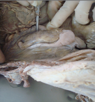 Showing paracolic appendix