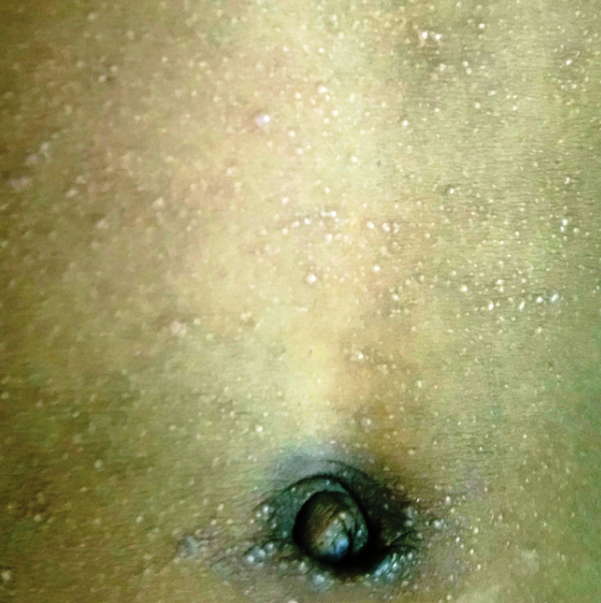 Multiple discrete papules over the abdominal wall.
