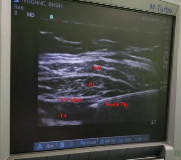 Sonographic View of Anatomy. EO-external oblique, IO-internal oblique, TAP-transversus abdominis plane, TA-transversus abdominis