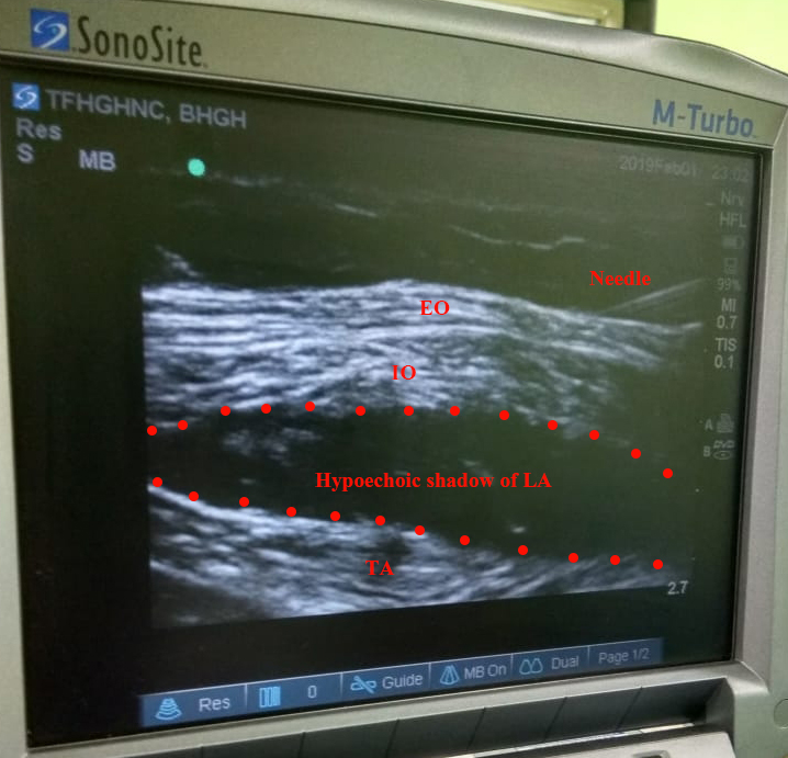 Desired spread of the local anesthetic in transversus abdominis plane. EO-external oblique, IO-internal oblique, LA-local anesthetics, TA-transversus abdominis