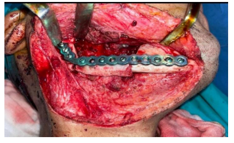 Monocortical bone graft from the iliac crest for reconstruction of lateral mandibular cortex