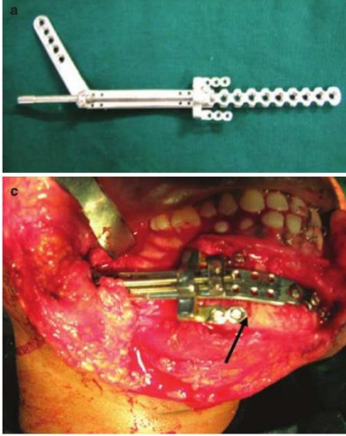 Fourth generation distractor device with an attached reconstruction plate