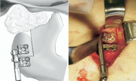 Neo-condyle formation by distraction osteogenesis