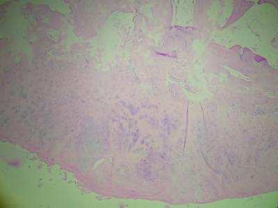 Cartilaginous cap with scattered chondrocytes