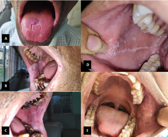 A-E: Clinical presentation of OLP encountered in the study