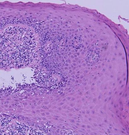 Histological features seen in OLP