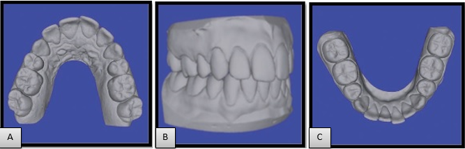 Three dimensional virtual models generated from CT scan of PVS