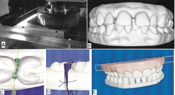 (A) Destructive scanner; (B), 3-D generated computer model; (C & D), Cutters separate teeth; and (E) Placement of virtual gingiva