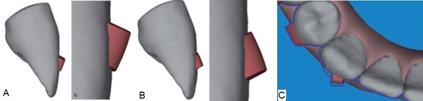 (A) Gingival beveled attachment; (B) Occlusal beveled Attachment; (C) Bevel attachment for rotation correction