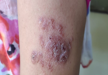 Lupus vulgaris; nodulo-plaque type on the upper limb
