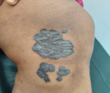 Lupus vulgaris; plaque type on lower limb