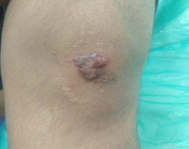 Tuberculosis verrucosa cutis (TBVC) on the lower limb