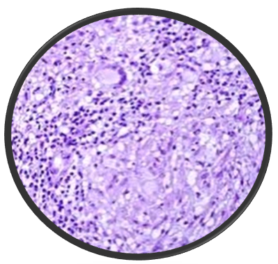 Histopathology ofScrofuloderma having granuloma with epitheloid cells