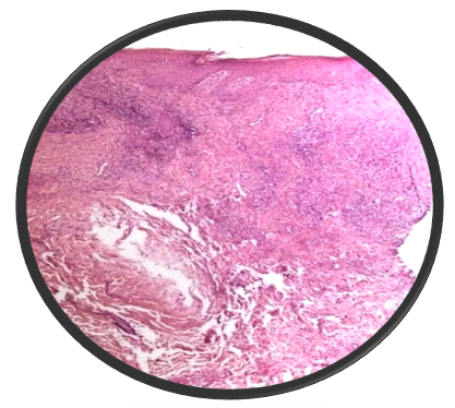 Histopathology of Lupus Vulgaris showing epithelioid granulomas in the upper dermis with lymphocytes and Langhans giant cells