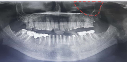 Ovoid shaped maxillary sinus