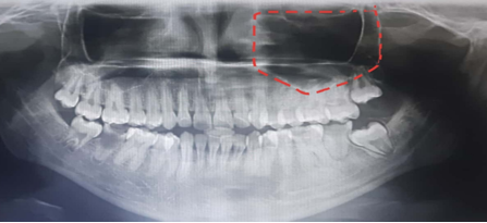 Pentagonal maxillary sinus