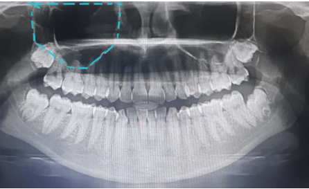 Hexagonal maxillary sinus