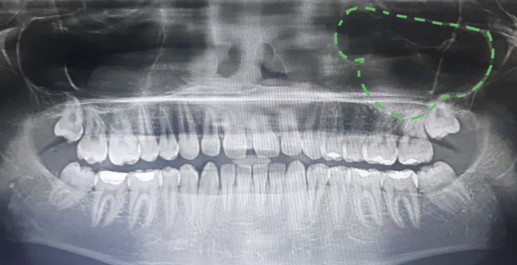 Cloudy shaped maxillary sinus