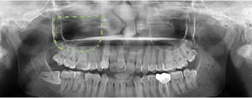 Rectangle shaped maxillary sinus