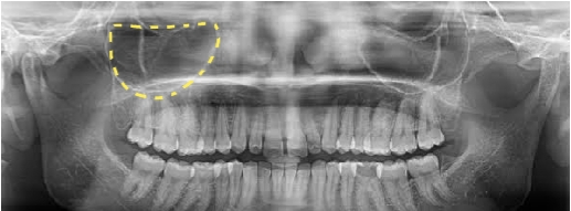 Round shaped maxillary sinus