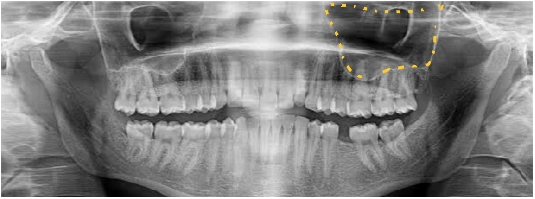Trapezoidal shaped maxillary sinus