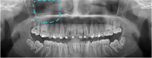 Squareshaped maxillary sinus 