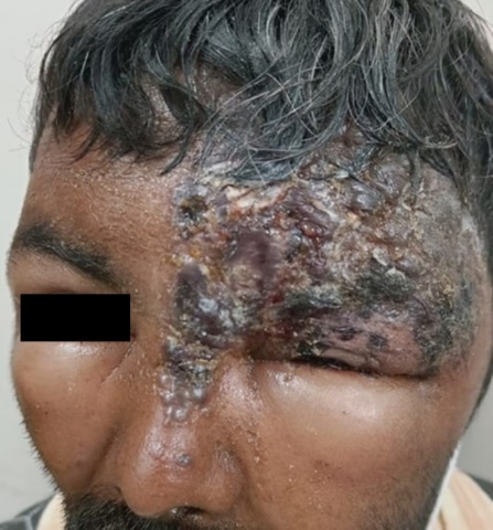 Multiple vesicles coalescing to form crusted erosion noted over left side forehead and nose with strict midline demarcation involving ophthalmic branch of trigeminal nerve with edema of bilateral eyelids.