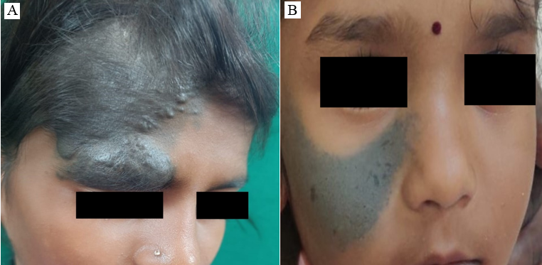 A: Solitary well to ill-defined blackish pigmented plaque of size 7cm x8cm noted over right side of forehead and upper eyelid along the ophthalmic branch of trigeminal nerve; B: Solitary well- defined greenish macule of size 3cm x 8cm noted over left side of face along maxillary division of trigeminal nerve.