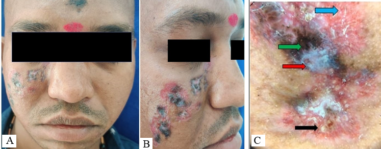 A: Multiple violaceous plaque distributed linearly over the right side of face along the distribution of maxillary division of trigeminal nerve (anterior view); B: Multiple violaceous plaque distributed linearly over the right side of face along the distribution of maxillary division of trigeminal nerve (lateral view); C; follicular plugging, (black arrow), whitish scales (red arrow), violaceous pigmentation (green arrow) and telangiectasia (blue arrow).
