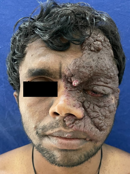 Solitary well defined dusky red erythematous plaque with surface nodularity noted involving the right slide of face along the ophthalmic and maxillary nerve distribution of trigeminal nerve