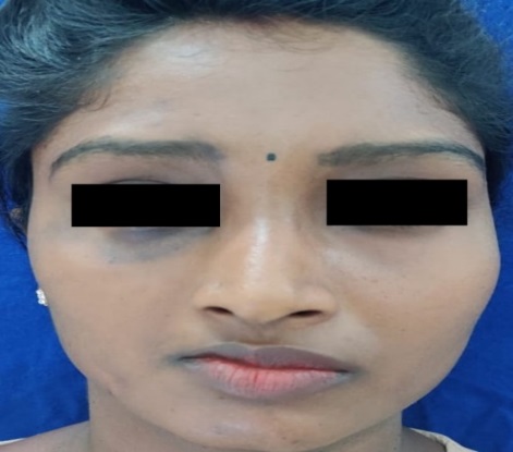 Right side atrophy of face involving ophthalmic, maxillary and mandibular division of trigeminal nerve leading asymmetry.