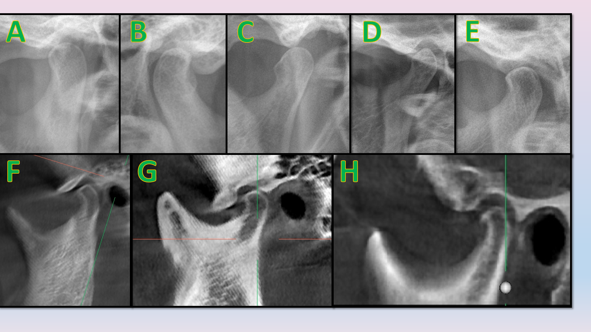 Anatomic variations of condyle on OPG (A = Round, B = Crooked finger, C = Bird beak, D = Diamond, E = Flat) and sagittal section of CBCT (F = Flat, G = Round, H = Beak)