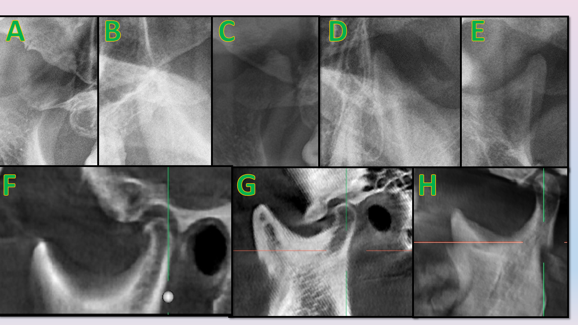 Anatomic variations of coronoid process on OPG (A = Round, B = Beak, C = Crooked finger, D = Triangular, E = Flat) and sagittal section of CBCT (F = Triangular, G = Round, H = Beak/hook)