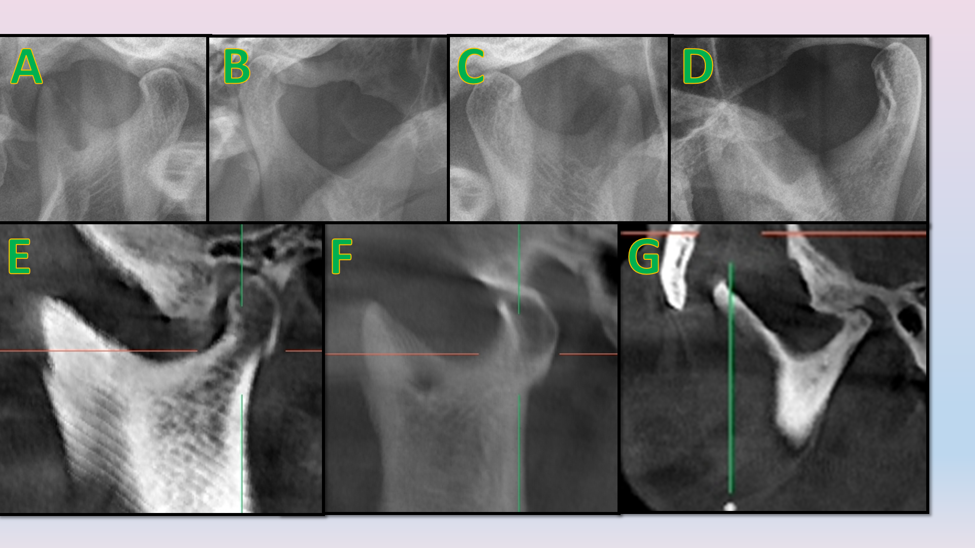 Anatomic variations of sigmoid notch on OPG (A = Round, B = Sloping, C = Flat, D = V-shaped) and sagittal section of CBCT (E = Wide, F = Round, G = Sloping)