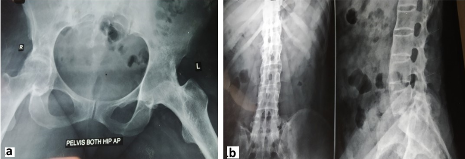 Pre-operative radiographs of patient showing bilateral ankylosed hip (a) and fusion of vertebral bodies with typical Bamboo spine appearance (b)