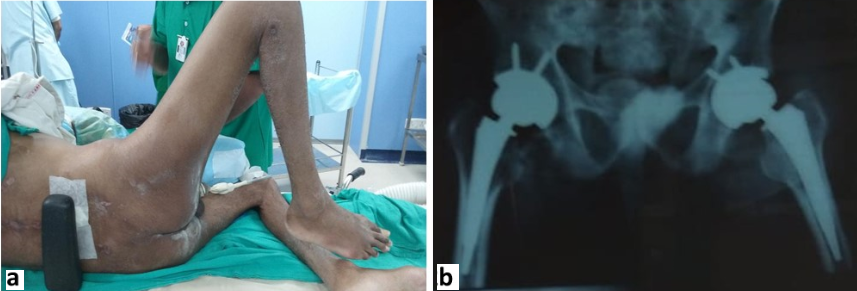 Pre-operative photograph of patient showing stiff hip with scars of bed sores (a) and Post-operative radiograph of same patient showing bilateral uncemented total hip arthroplasty (b)
