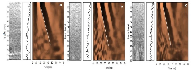 Fibroscan images showing LSM of a) 7.4 kpa – F1 fibrosis b) 11.1 Kpa – F2 fibrosis c) 12.8 kpa – F3 fibrosis