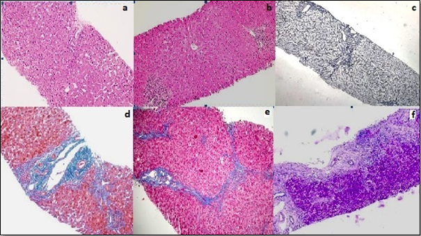 Liver biopsy images showingIshak fibrosis stages 