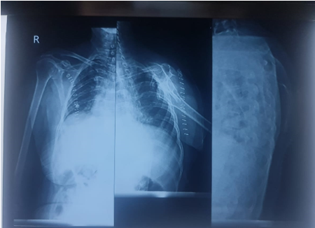 Xray: Well defined lucent lesion with thin sclerotic rim at inferior angle of scapular lesion