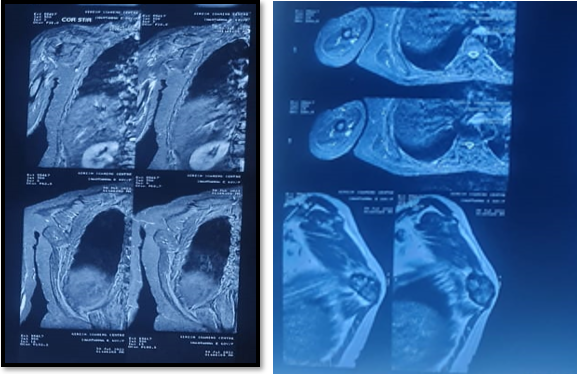 MRI right scapular showed that exophytic T2 hypointense & STIR mixed intensity lesion measuring 5 x 4.5x2.3cms in inferior angle of scapula suggestingBenign exophytic lesion from inferior angle of scapula with surrounding soft tissue mass Exostosis.