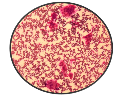 Giemsa 40X: FNACOf right scapular lesion showed in dense haemorrhagic background multinucleated giant cells containing 20-80 nuclei which are round to oval uniform with bland chromatin and inconspicuous nucleoli. 