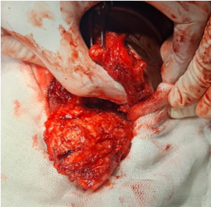 Intraoperative pic shows firm to hardGrey white tissue mass measuring 6.5x4x2.5cm irregular mass attached at inferior angle of scapula. On cut section cystic and solid areas noted with areas of haemorrhage.