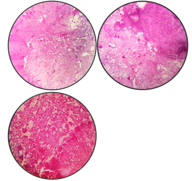 H & E 40X: solid and cystic tumour composed of mixture of sheets of mononuclear cells and multinucleated giant cells. These mononuclear cells are round to polygonal with clear cytoplasm and distinct cytoplasmic borders. The nucleoli are oval bland with few longitudinal groves and occasional mitosis. Irregular zone pf focal calcification (chicken wire type and areas of chondroid differentiated noted. Interspersed among these are multinucleated osteoclastic type giant cells. Also seen are large areas of haemorrhage rimmed by osteoclast giant cells noted (ABC like areas).