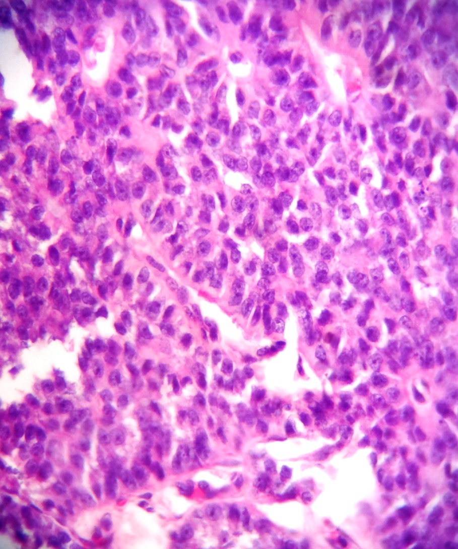 Granulosa cell tumor: Tumor cells with scant eosinophilic cytoplasm and pale, round to oval nuclei with few showing nuclear grooves
