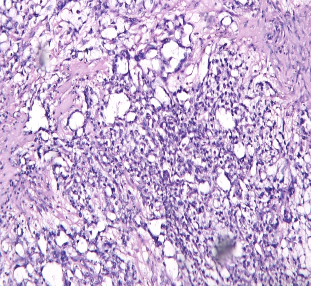 Yolk sac tumor: Tumor cells are arranged in reticular and micro-cystic pattern