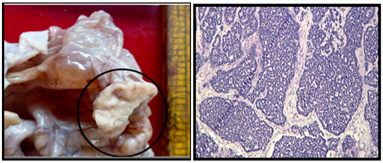 Borderline mucinous with neuroendocrine carcinoma: Multiloculated cyst filled with thick gelatinous fluid shows a solid mural nodule of size 3x1.5x1cm. : Section from mural nodule showing moderately differentiated neuroendocrine carcinoma.