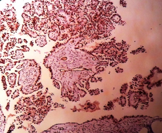 Micropapillary variant of serous with WT1 positivity